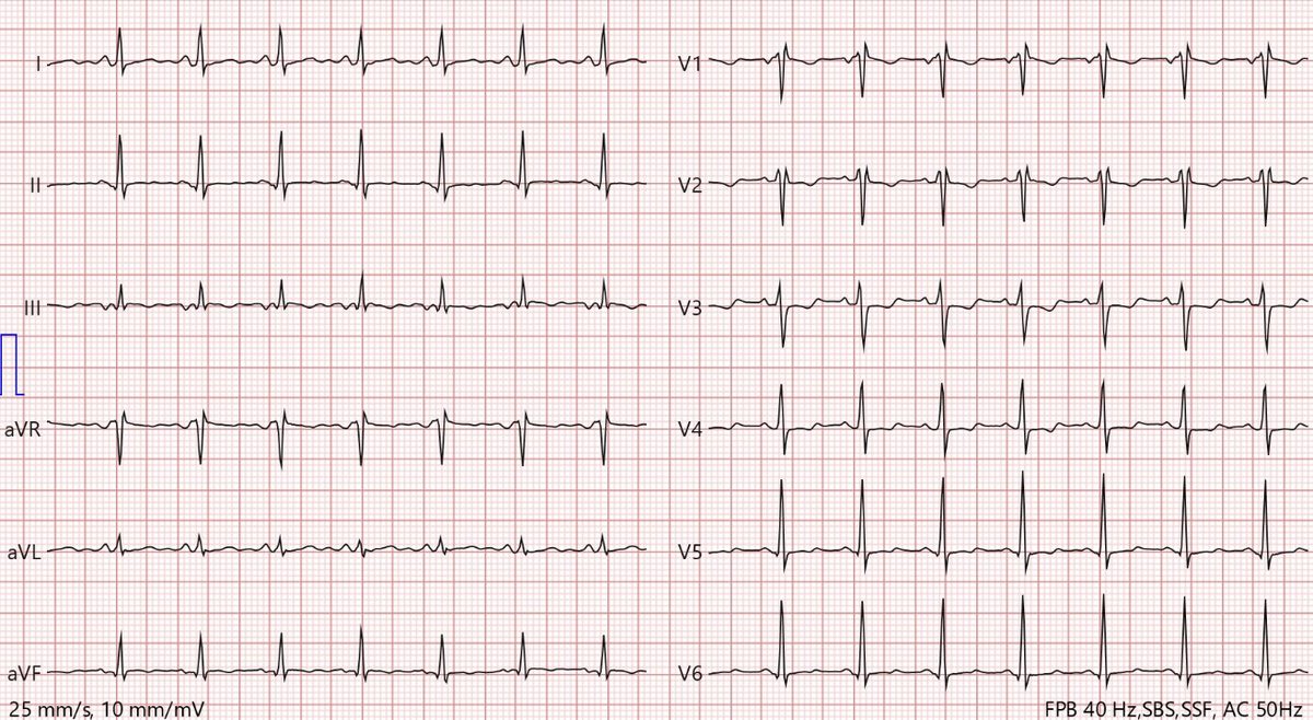 Électrocardiogramme douze dérivations montrant des anomalies diffuses de repolarisation.