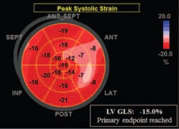 Carte polaire de strain longitudinal du ventricule gauche, valeur globale abaissée.
