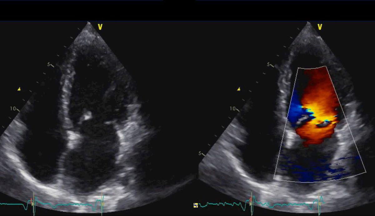 Coupe apicale de la valve mitrale, en 2D et en Doppler couleur montrant une fuite.