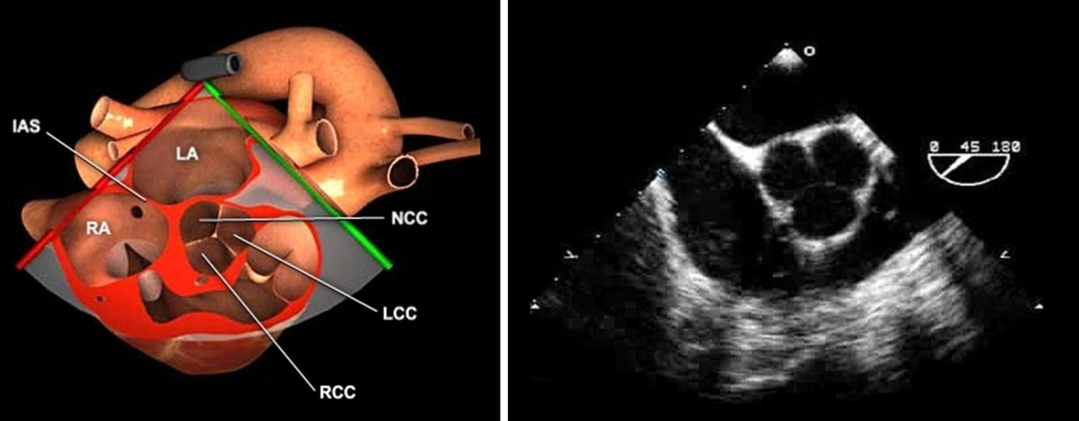 Rendu anatomique en trois dimensions et image échographique réelle montrant les trois sigmoïdes de la valve aortique en petit axe à 45° en ETO.