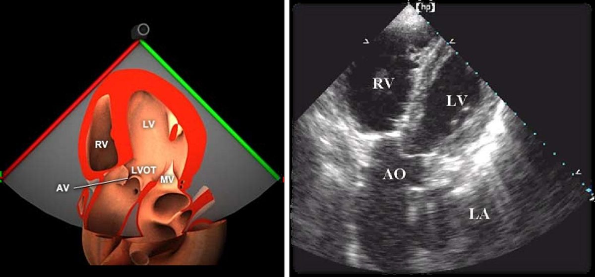 Rendu anatomique en trois dimensions et image échographique réelle de la vue transgastrique grand axe en ETO.