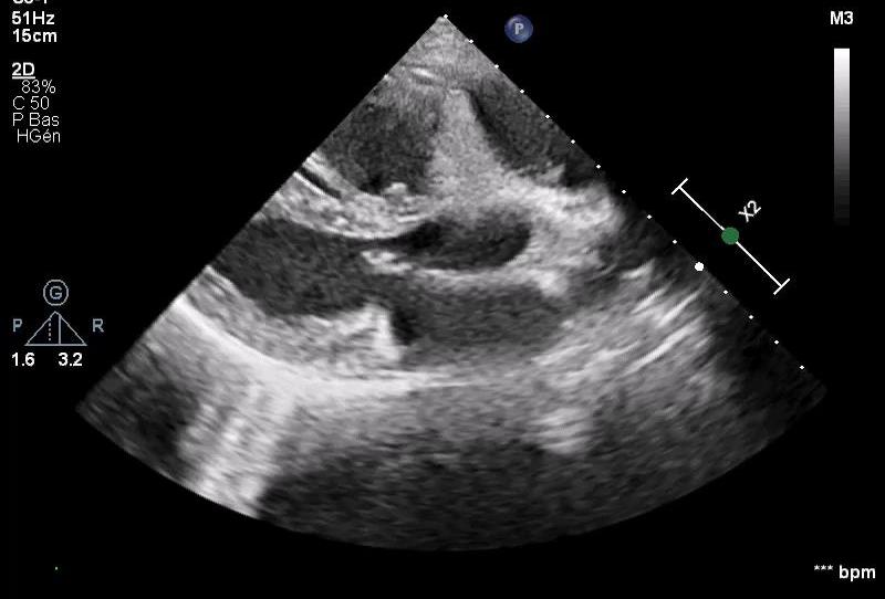 Image échographique réelle en coupe parasternale grand axe, avec et sans Doppler couleur.