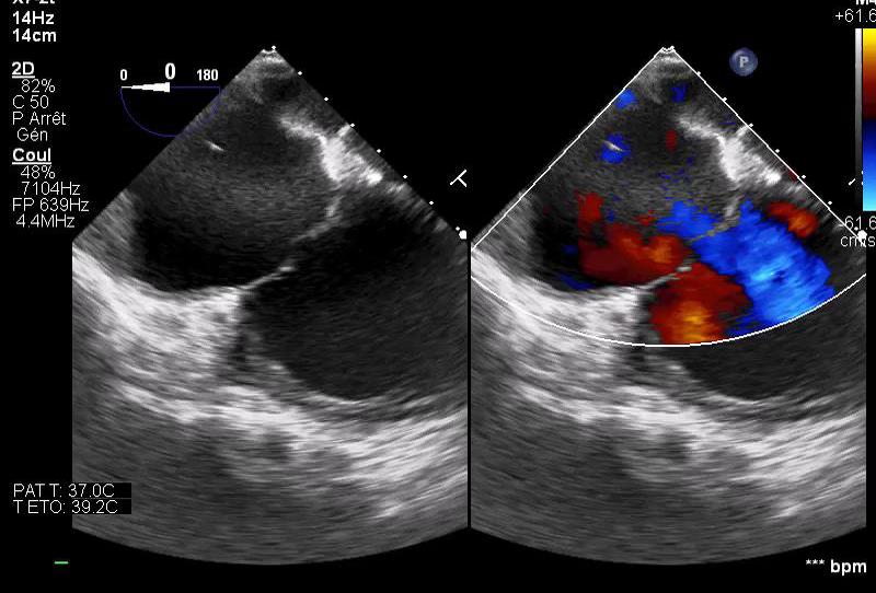 Image échographique transœsophagienne réelle montrant un shunt interauriculaire en Doppler couleur.