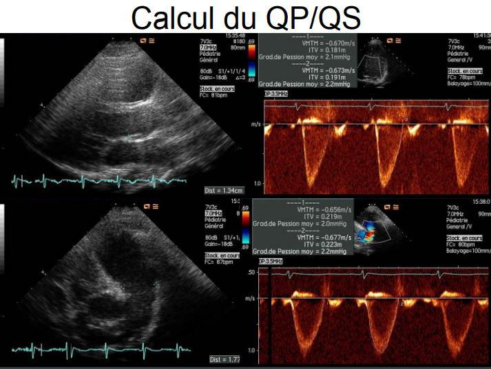 Tracés Doppler réels illustrant la méthode de calcul du rapport Qp/Qs.