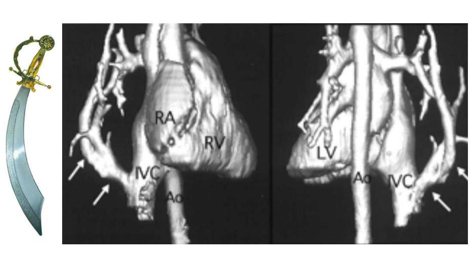 Comparaison entre un sabre cimeterre et une reconstruction tomodensitométrique montrant l'anomalie veineuse caractéristique du syndrome du même nom.