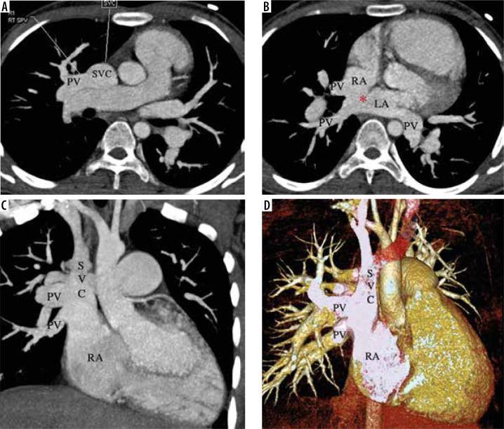 Reconstructions tomodensitométriques en coupes et en volume montrant le trajet anormal d'une veine pulmonaire.
