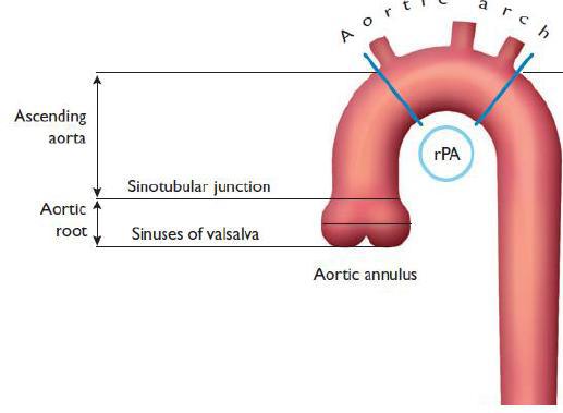 Schéma anatomique de la racine aortique et de l'aorte ascendante avec ses repères de mesure.