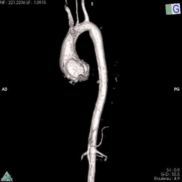 Reconstruction tomodensitométrique 3D réelle de l'aorte thoracique avec dilatation de la racine aortique.