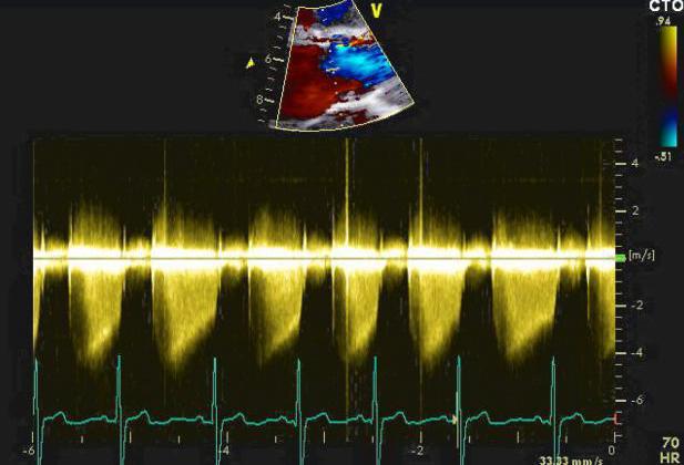 Tracé Doppler continu réel montrant un flux de régurgitation holodiastolique caractéristique d'une insuffisance aortique sévère.