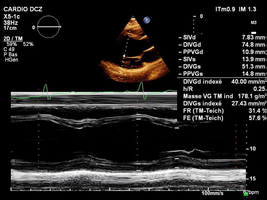 Image échographique réelle en mode temps-mouvement montrant les mesures d'un ventricule gauche dilaté.