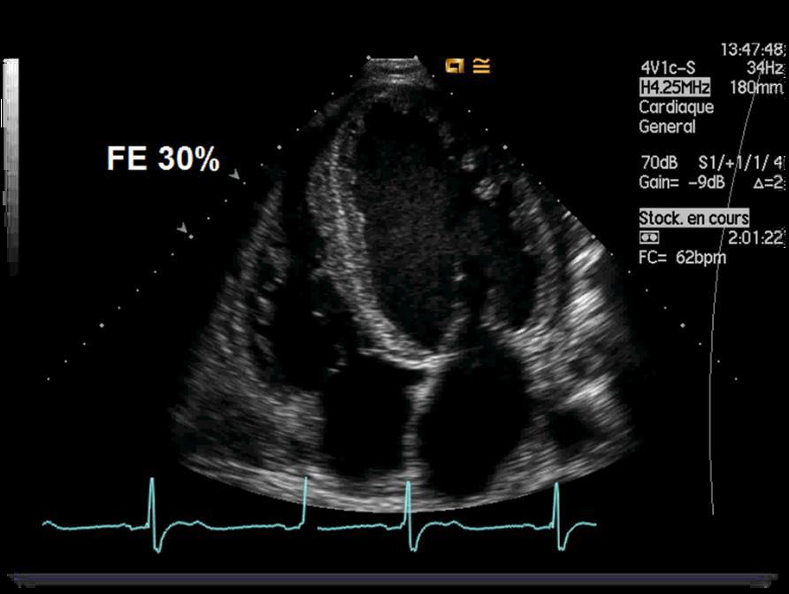 Image échographique réelle en coupe apicale quatre cavités montrant un ventricule gauche à fonction systolique réduite.