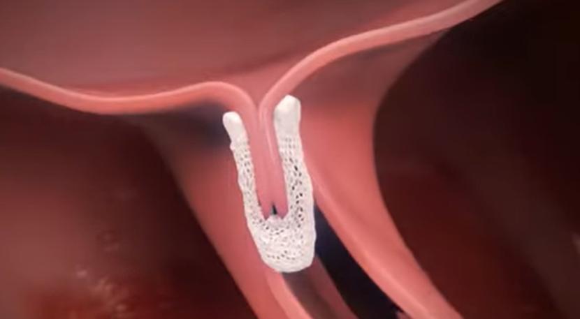 Illustration animée du clip mitral refermé sur les deux feuillets, créant un double orifice.