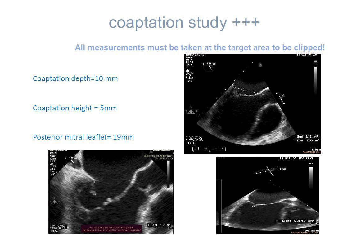 Images échographiques réelles montrant les mesures de coaptation avant la pose d'un clip mitral.