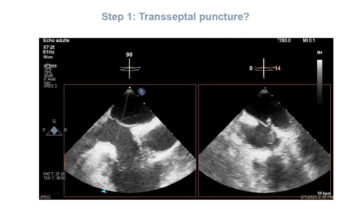 Image échographique transœsophagienne réelle en imagerie biplan guidant une ponction transseptale.