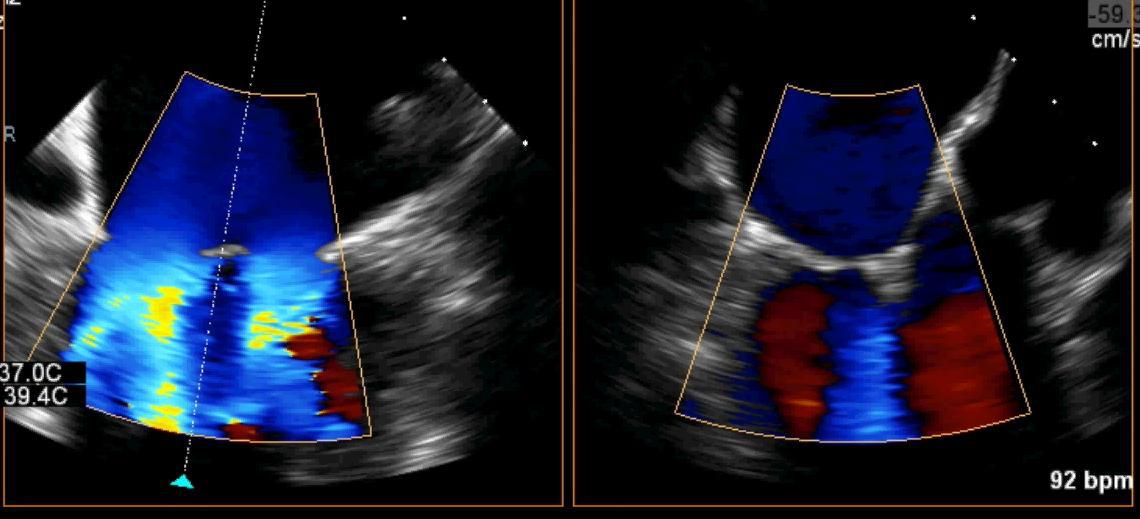 Images échographiques réelles en Doppler couleur comparant le jet régurgitant avant et après pose du clip.