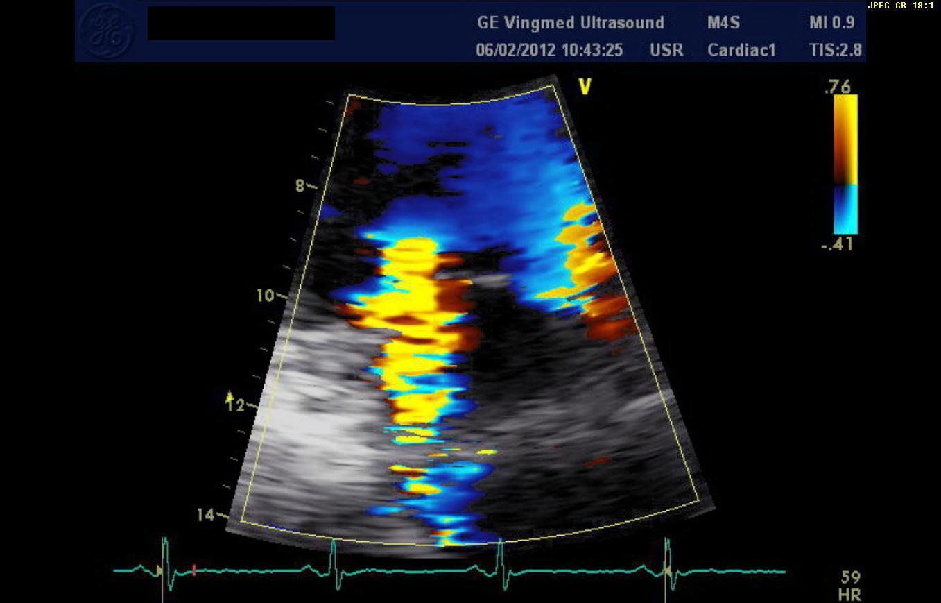 Image échographique réelle en Doppler couleur montrant une insuffisance tricuspide sévère.