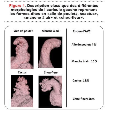 Planche illustrée présentant les quatre morphologies classiques de l'auricule gauche et leur risque relatif d'AVC.