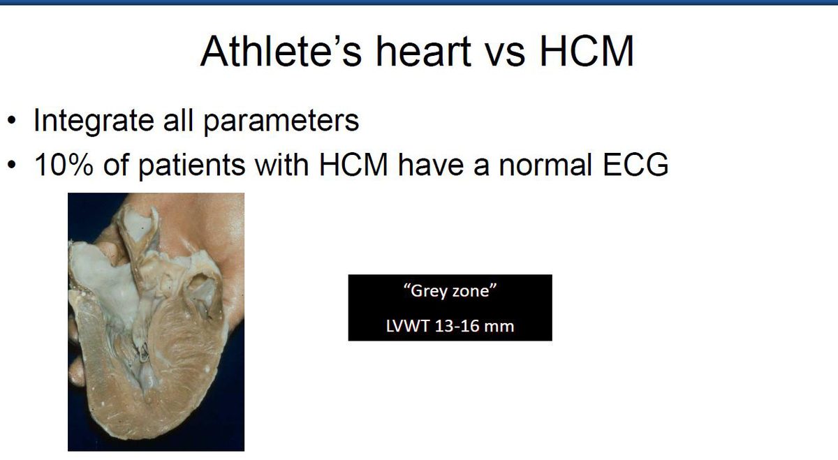 Pièce anatomique de cœur d'athlète en coupe, avec un encart rappelant la zone grise d'épaisseur pariétale et la proportion de CMH à ECG normal.