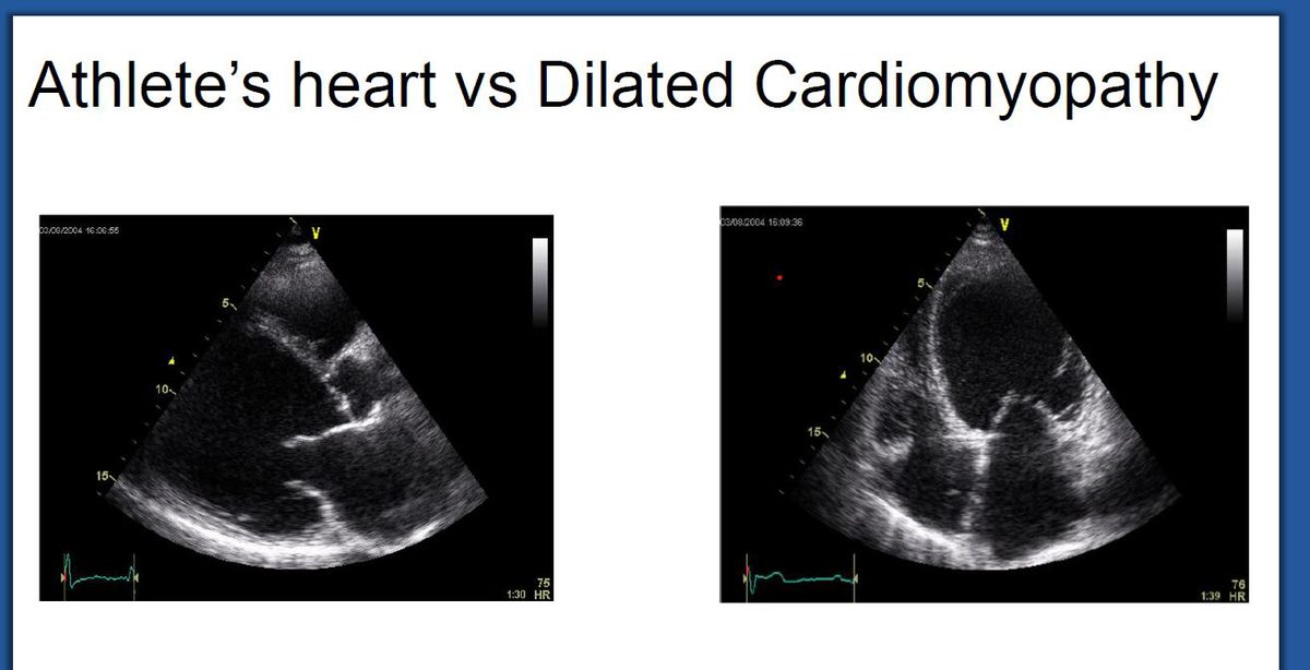 Deux coupes échographiques quatre cavités comparant un ventricule gauche normal à un ventricule gauche dilaté de cardiomyopathie dilatée.
