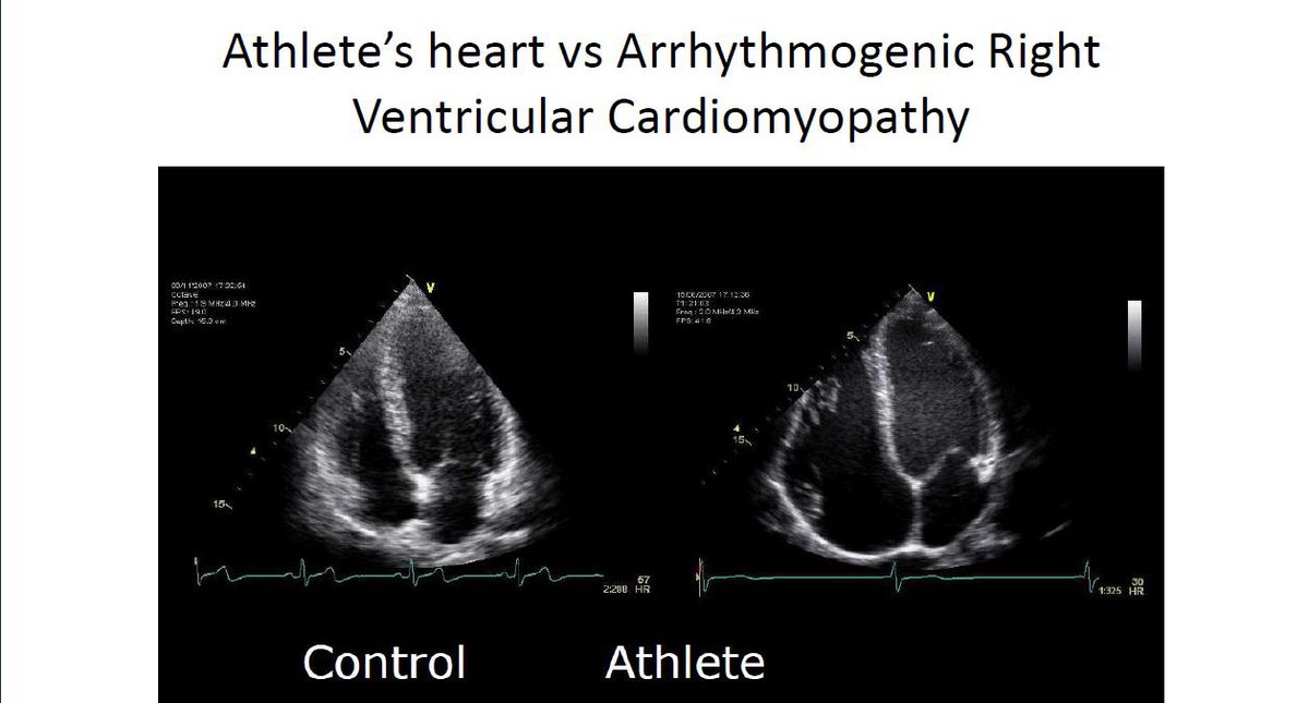 Deux coupes échographiques quatre cavités comparant le ventricule droit d'un témoin à celui d'un athlète, sans anomalie de dysplasie arythmogène.