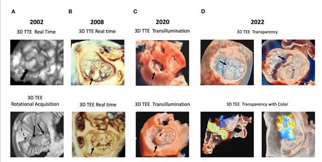 Quatre rendus 3D de la même valve mitrale prolabée entre 2002 et 2022, illustrant l'évolution des techniques de rendu volumique.