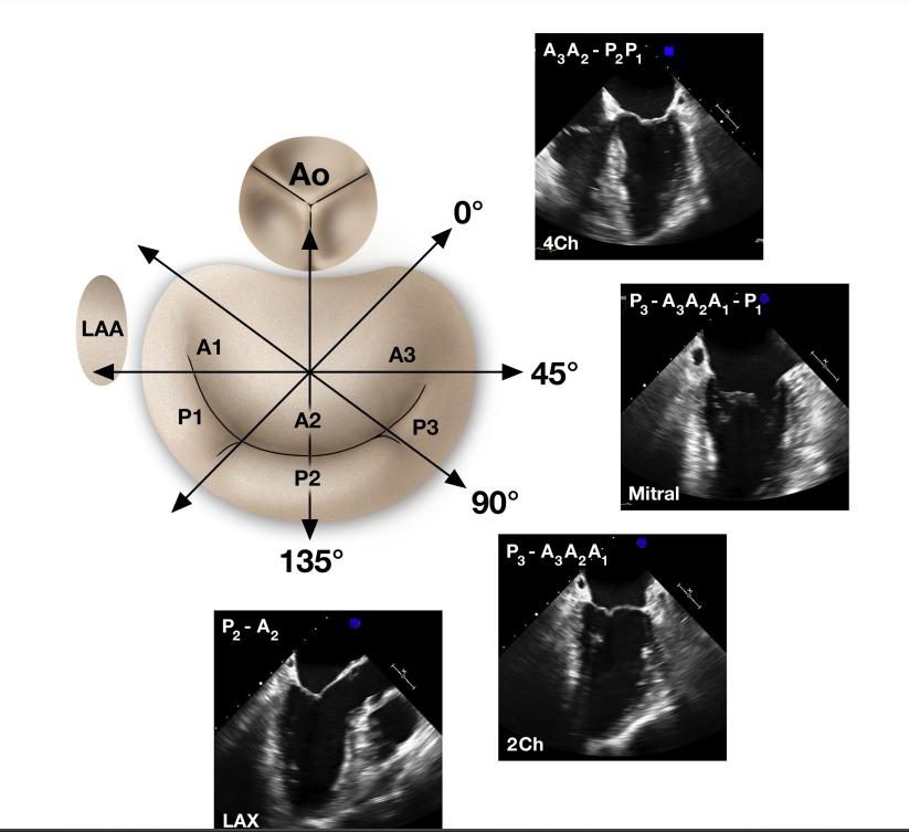 Schéma en cadran horaire de la valve mitrale associant les angles de rotation du plan de coupe aux segments A1-A3 et P1-P3, avec les coupes échographiques correspondantes.