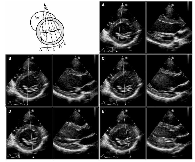 Schéma de cinq plans de coupe parallèles balayant la valve mitrale des segments postérieurs vers les segments antérieurs, avec les cinq paires d'images échographiques correspondantes.