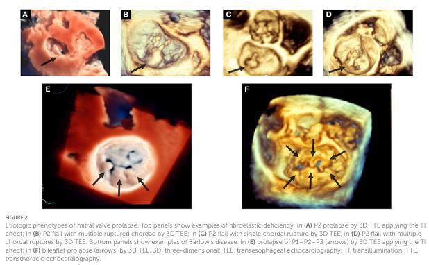 Six rendus échocardiographiques 3D comparant la déficience fibro-élastique, à lésion unique, et la maladie de Barlow, à atteinte diffuse.