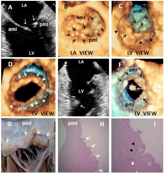 Planche de neuf images reliant des coupes échographiques 2D, des rendus 3D, une pièce anatomique et des coupes histologiques d'un même feuillet mitral prolabé.