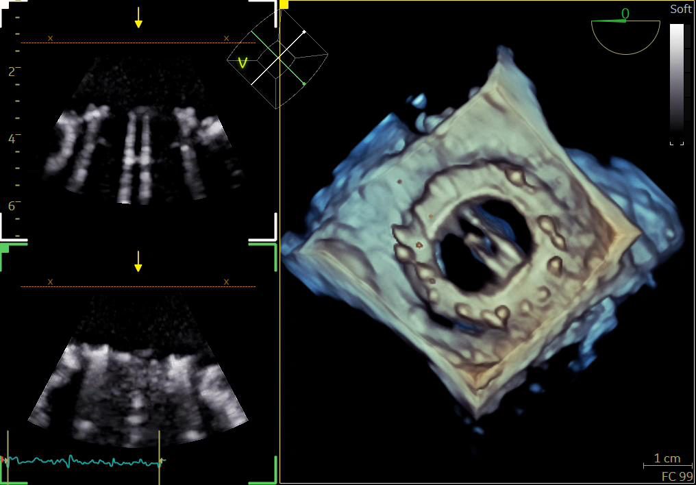 Rendu 3D en transillumination de l'anneau mitral, associé à deux coupes échographiques 2D de référence.