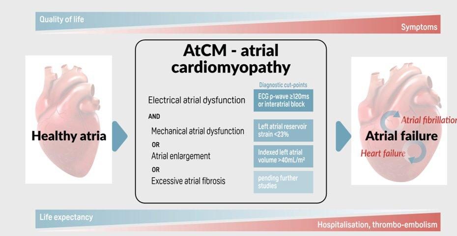 Schéma conceptuel montrant l'évolution d'une oreillette saine vers une oreillette défaillante, avec un encart listant les critères électriques, mécaniques et structurels de la cardiomyopathie atriale.