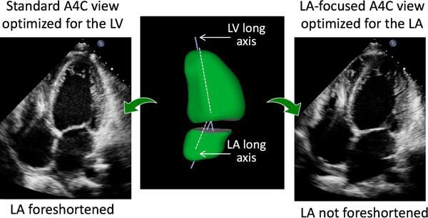 Comparaison échographique de deux incidences quatre cavités du même patient, l'une centrée sur le ventricule gauche avec l'oreillette raccourcie, l'autre centrée sur l'oreillette gauche non raccourcie.