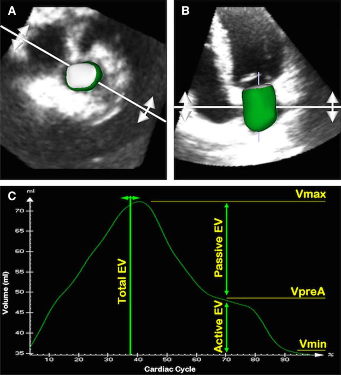 Planche en trois panneaux montrant le contour endocardique de l'oreillette gauche en 3D et la courbe de volume atrial sur un cycle cardiaque, avec les repères Vmax, VpréA et Vmin.