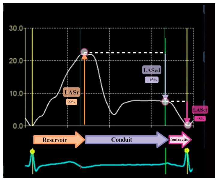 Courbe de strain longitudinal atrial par speckle-tracking montrant les trois phases réservoir, conduit et contraction, avec les valeurs LASr, LAScd et LASct.