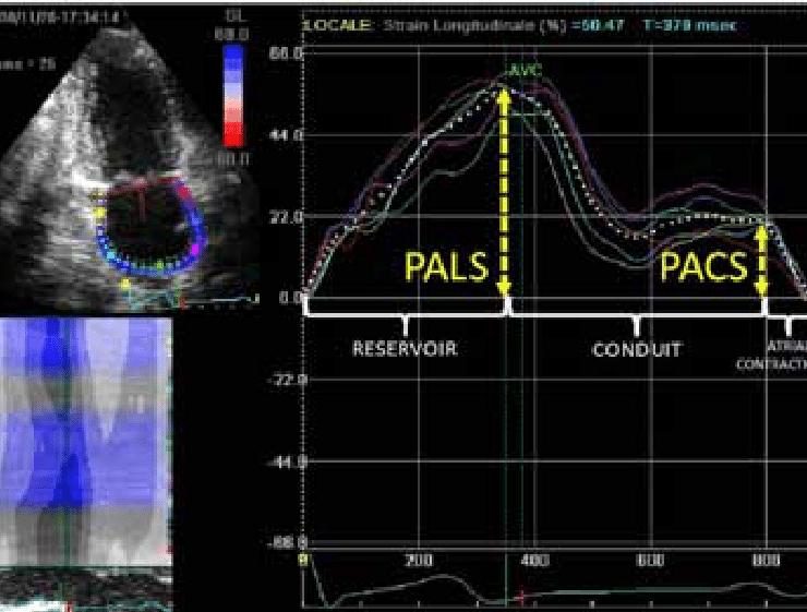 Tracé de strain longitudinal atrial en speckle-tracking avec les repères PALS et PACS annotés sur des courbes segmentaires superposées.