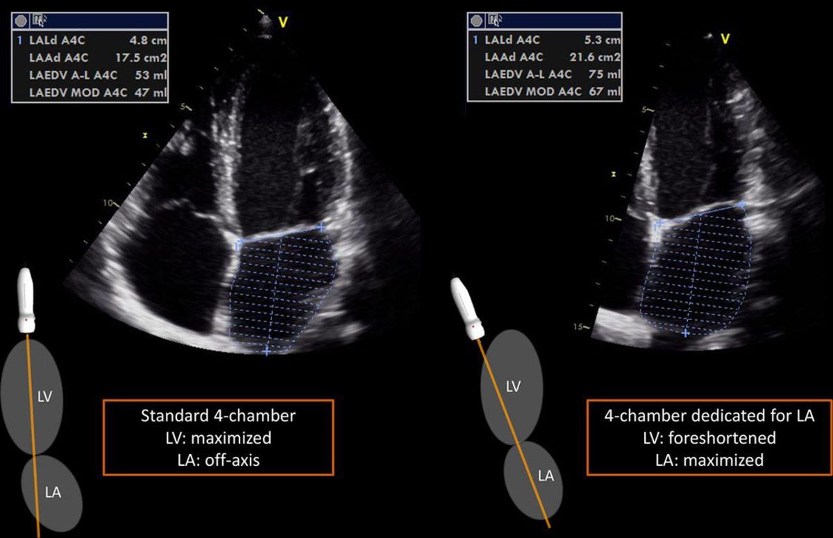 Deux coupes échographiques quatre cavités de la même patiente avec les mesures chiffrées du diamètre, de la surface et du volume atrial gauche selon l'incidence utilisée.