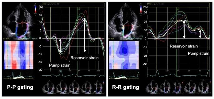 Comparaison de deux courbes de strain atrial obtenues chez le même patient selon un gating P-P ou un gating R-R, montrant des amplitudes réservoir différentes.