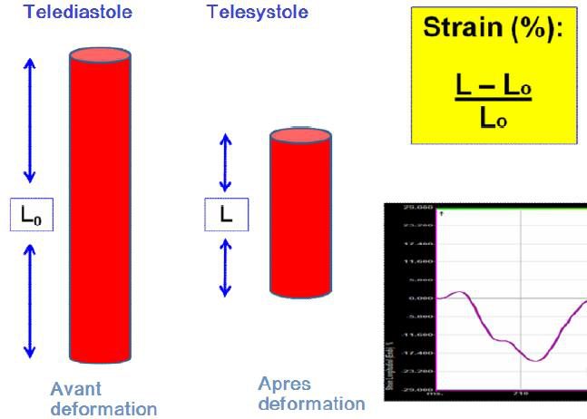 Schéma d'un cylindre myocardique se raccourcissant entre la télédiastole et la télésystole, avec la formule du strain et un exemple de courbe réelle.
