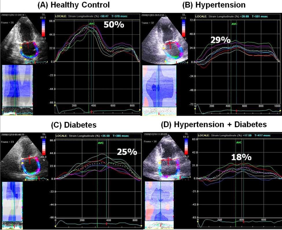 Quatre courbes de strain atrial de réservoir chez un témoin sain et des patients hypertendus, diabétiques ou les deux, montrant un gradient de réduction.