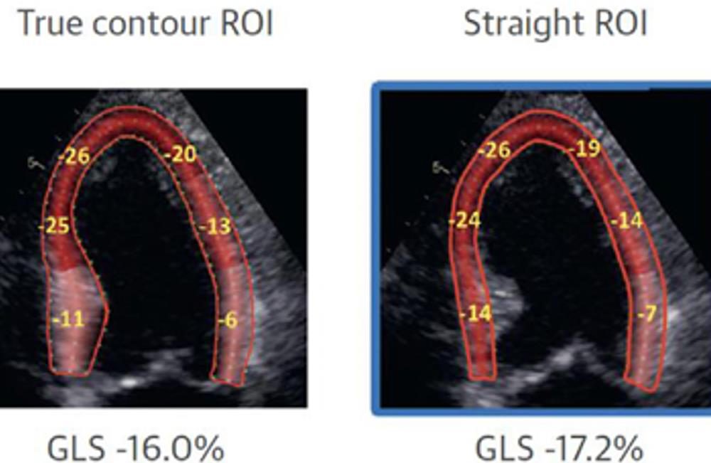 Deux tracés de la région d'intérêt sur la même coupe apicale, l'un suivant le contour réel de l'endocarde, l'autre plus rectiligne, avec leurs valeurs de strain respectives.