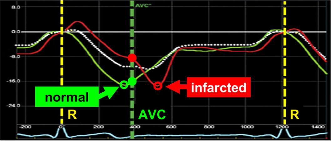Courbes de strain longitudinal comparant un segment myocardique normal et un segment infarci sur un même cycle cardiaque.