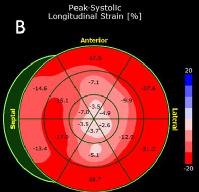 Carte polaire (bullseye) du strain longitudinal systolique du ventricule gauche, tous les segments représentés en cercles concentriques colorés.