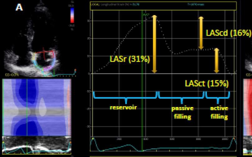 Courbe de strain atrial longitudinal montrant les trois phases réservoir, conduit et contraction, avec un panneau échographique associé.