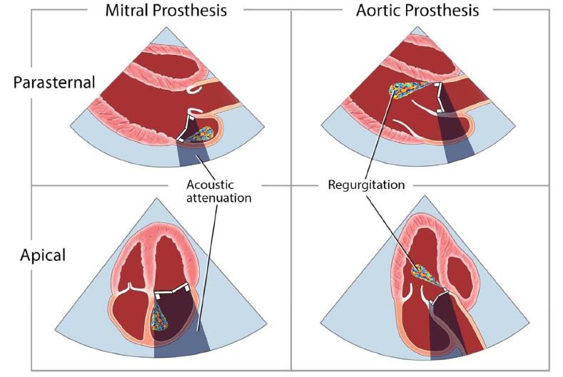 Schéma en quatre panneaux montrant le cône d'ombre acoustique d'une prothèse mitrale et d'une prothèse aortique, en incidences parasternale et apicale.