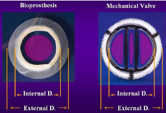 Photographie comparative de face d'une bioprothèse et d'une valve mécanique à double ailettes, avec leurs diamètres interne et externe annotés.