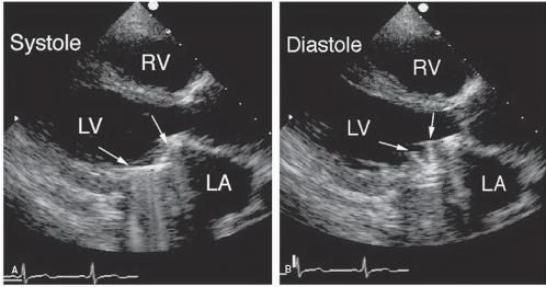 Coupe échocardiographique apicale en deux images côte à côte, systole et diastole, montrant la mobilité normale d'une prothèse mitrale entre le ventricule gauche et l'oreillette gauche.