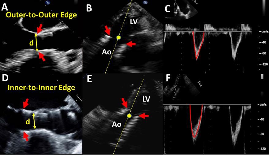 Planche de six images échocardiographiques comparant la mesure du diamètre prothétique de bord externe à bord externe et de bord interne à bord interne, avec leurs enveloppes Doppler correspondantes.