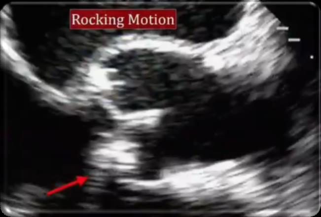 Coupe échocardiographique montrant le rocking motion d'une prothèse mitrale désinsérée, avec une flèche désignant le point de bascule.