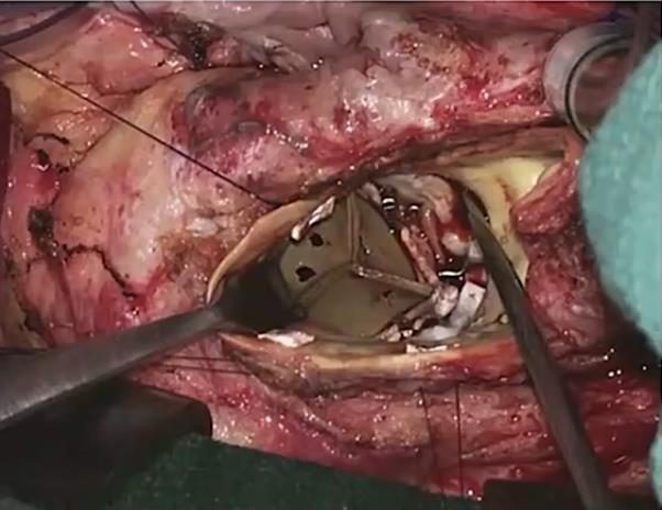 Photographie peropératoire d'un champ chirurgical cardiaque montrant la mise en place d'une prothèse valvulaire mécanique par des fils de suture.