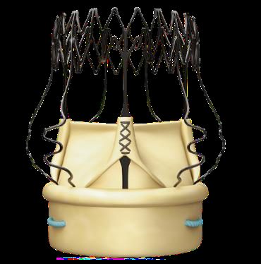 Illustration d'une valve cardiaque percutanée auto-expansible, armature métallique en treillis portant les feuillets biologiques déjà montés.